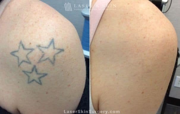 Understanding Laser Tattoo Removal: How It Works